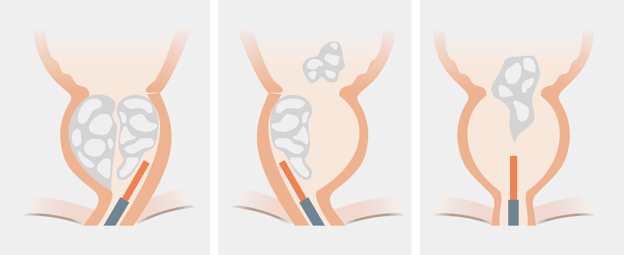 BPH enucleation