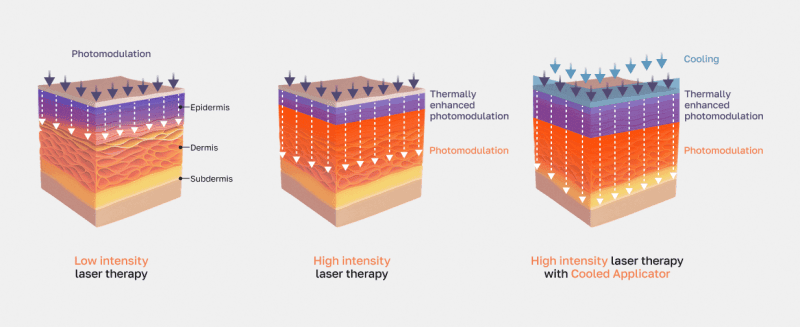 Comparison of laser therapy effectiveness